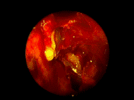 fluoropreop.2