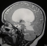 Idrocefalo congenito RM sagittale T2-pesata